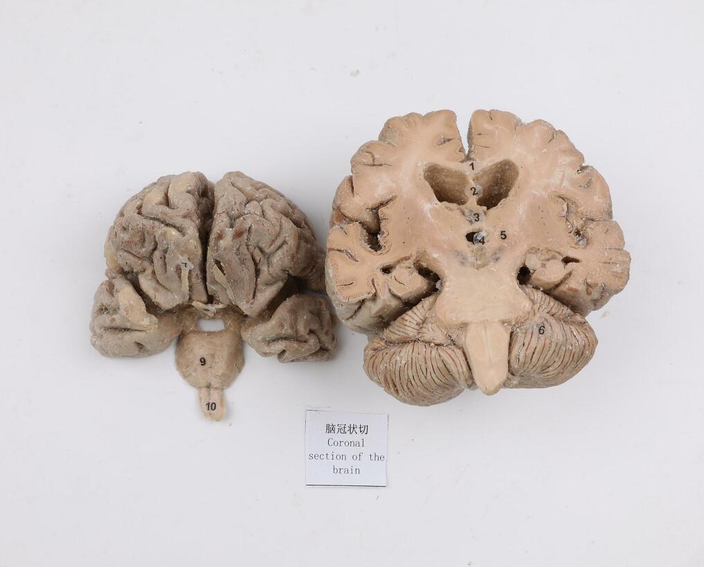 plastianted brain