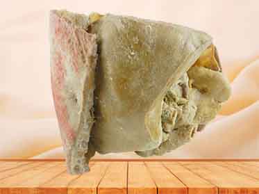 Liver spleen pancreas  and duodenum specimen