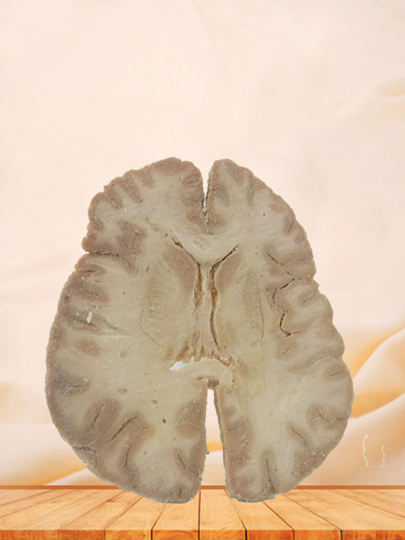 Horizontal section of brain through inner capsule