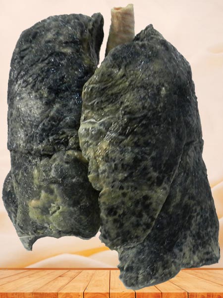 smoker lung plastinated specimen