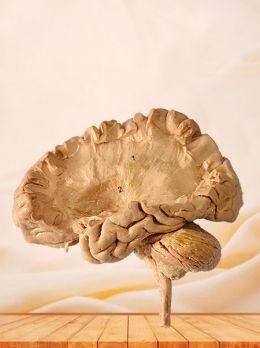 Internal capsule fiber plastinated specimen