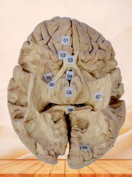 Tractus opticus and optic radiation plastinated specimen