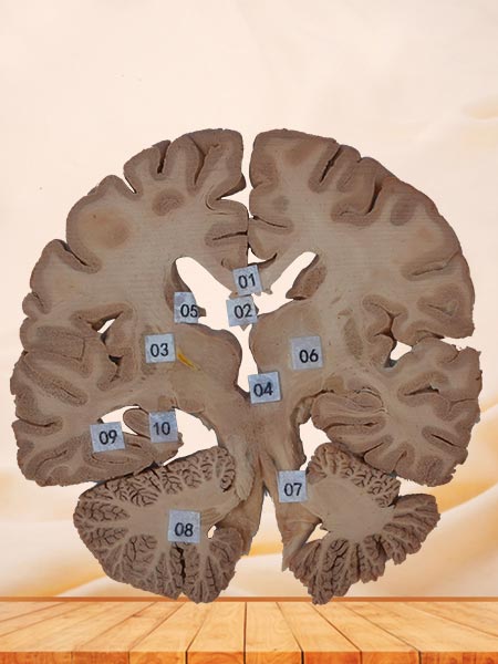 coronal section of brain specimen