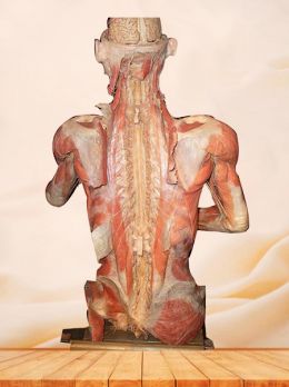 Patient plastinated specimen