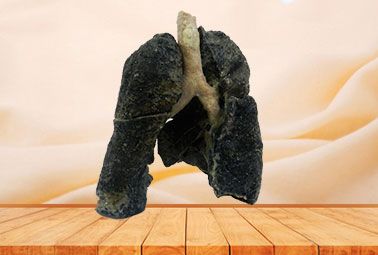 Smoker lung plastinated specimen