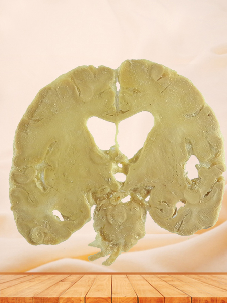coronal section of brain medical specimen