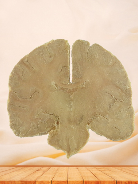 coronal section of human brain plastinated specimen