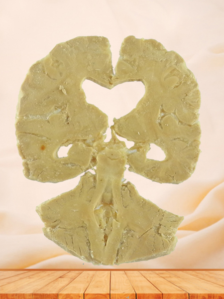 coronal section of human brain plastination