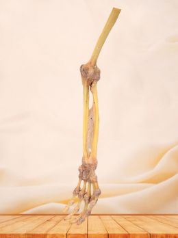 Human forearm bone union specimen