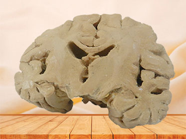 Coronal section of brain