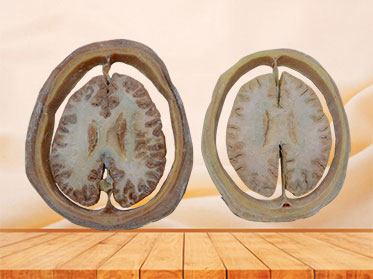 Head slice callosum plastinated specimen