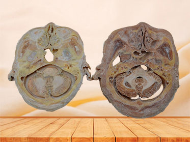Head slice hyperphysi plastinated specimen