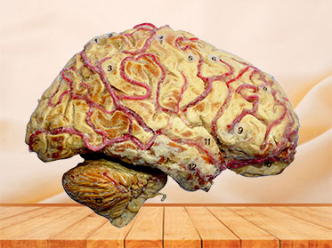 Human cerebral hemisphere and brain stem plastination