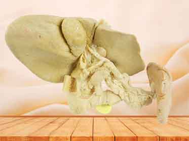 Pancreas spleen and duodenum specimen