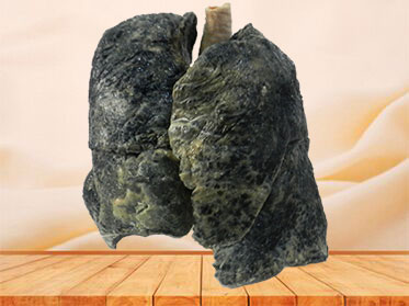 The lung of smoker plastinated specimen