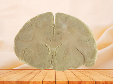 coronal section of brain