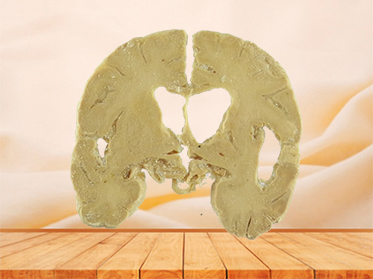 coronal section of human brain