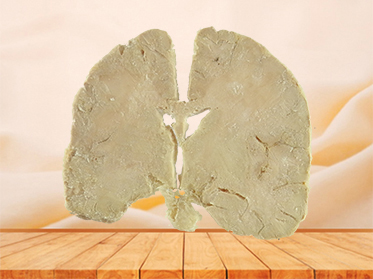 coronal section of human brain plastinated specimen