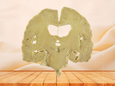 coronal section of human brain specimen