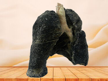 smoker lung anatomy specimen