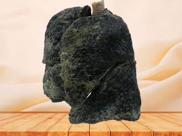 smoker lung plastinated specimen