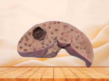 Bile Duct Epithelial Liver Cancer Anatomy Model