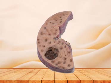 Bile Duct Epithelial Liver Cancer Model