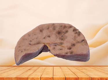 Bile Duct Epithelial Liver Cancer Silicone Model