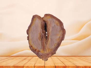 Breast Cancer Anatomy Model