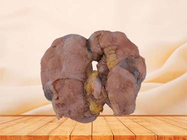 Cavernous Renal Tuberculosis Anatomy Model
