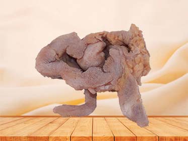 Ileocecal Adenocarcinoma Anatomy Model