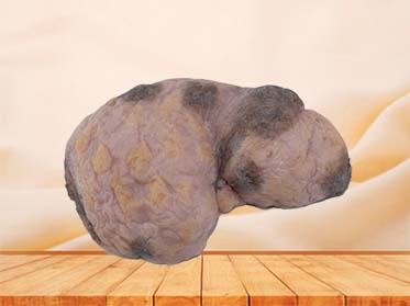 Ovarian Cancer Anatomy Model