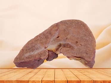 Portal Cirrhosis Complicated with Cell Carcinoma Anatomy Model