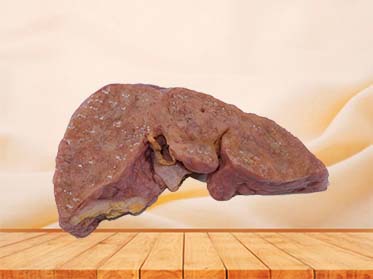 Portal Cirrhosis Complicated with Cell Carcinoma Model