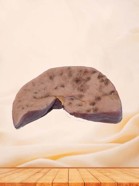 High Simulation Bile Duct Epithelial Liver Cancer Pathology Specimen