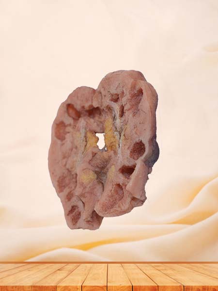 Soft Simulated Human Cavernous Renal Tuberculosis Pathology Model