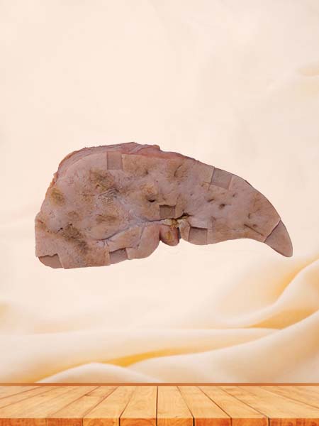 Soft Simulated Hepatic Vascular Endothelial Cell Sarcoma Silicone Model
