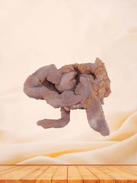 Soft Simulated Ileocecal Adenocarcinoma Pathology Model