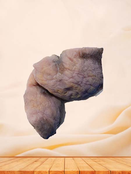 Soft Simulated Female Ovarian Cancer Model