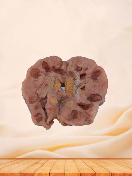 Soft Simulated Human Cavernous Renal Tuberculosis Pathology Model