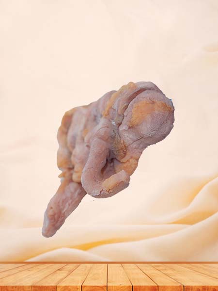 Soft Simulated Ileocecal Adenocarcinoma Pathology Model