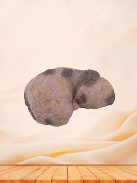 Soft Simulated Female Ovarian Cancer Model