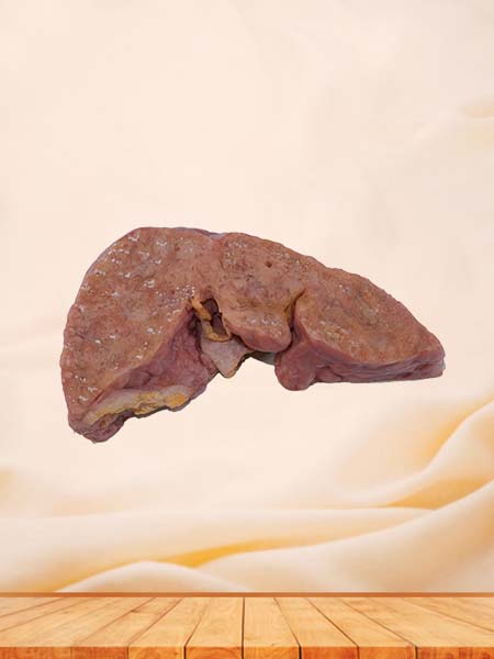 Human Portal Cirrhosis Complicated with Cell Carcinoma Pathology Specimen