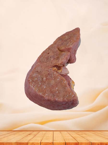 Human Portal Cirrhosis Complicated with Cell Carcinoma Pathology Specimen