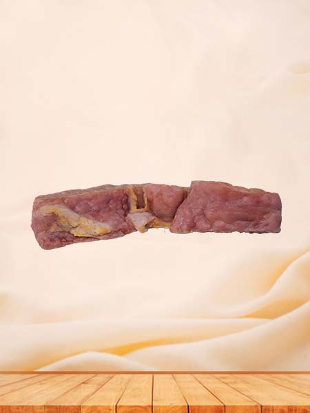 Human Portal Cirrhosis Complicated with Cell Carcinoma Pathology Specimen