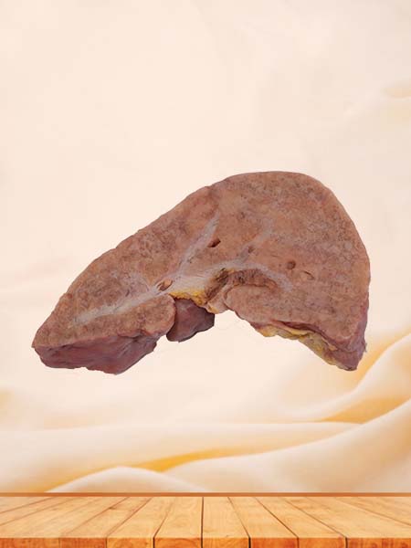 Human Portal Cirrhosis Complicated with Cell Carcinoma Pathology Specimen