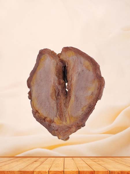 Soft Simulated Silicone Breast Cancer Model