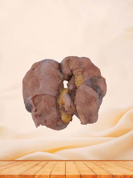 Soft Simulated Human Cavernous Renal Tuberculosis Pathology Model