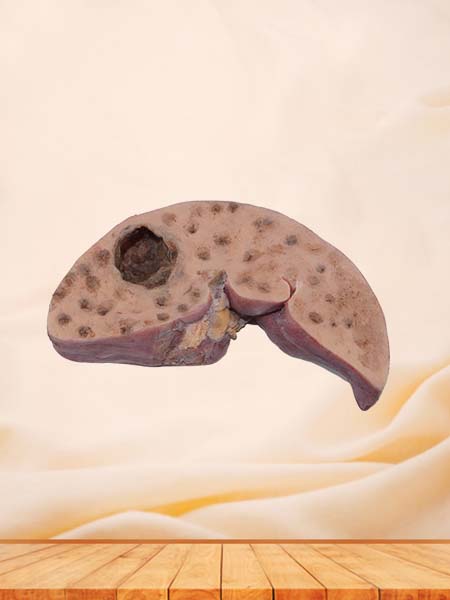 High Simulation Bile Duct Epithelial Liver Cancer Pathology Specimen