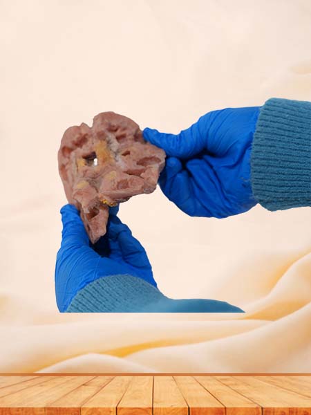 Soft Simulated Human Cavernous Renal Tuberculosis Pathology Model